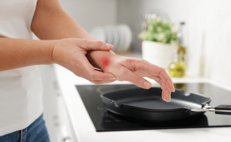 The Basic of Burn Wounds and Their Treatments