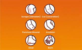 Introduction to Wound Types