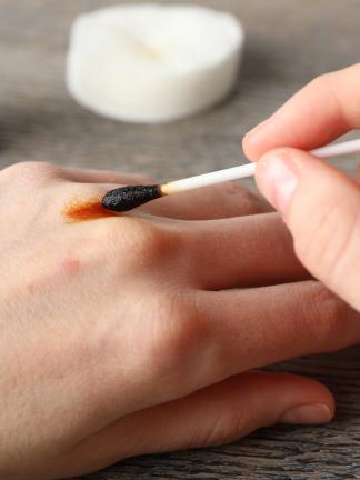 hands with wound being treated by an antiseptic